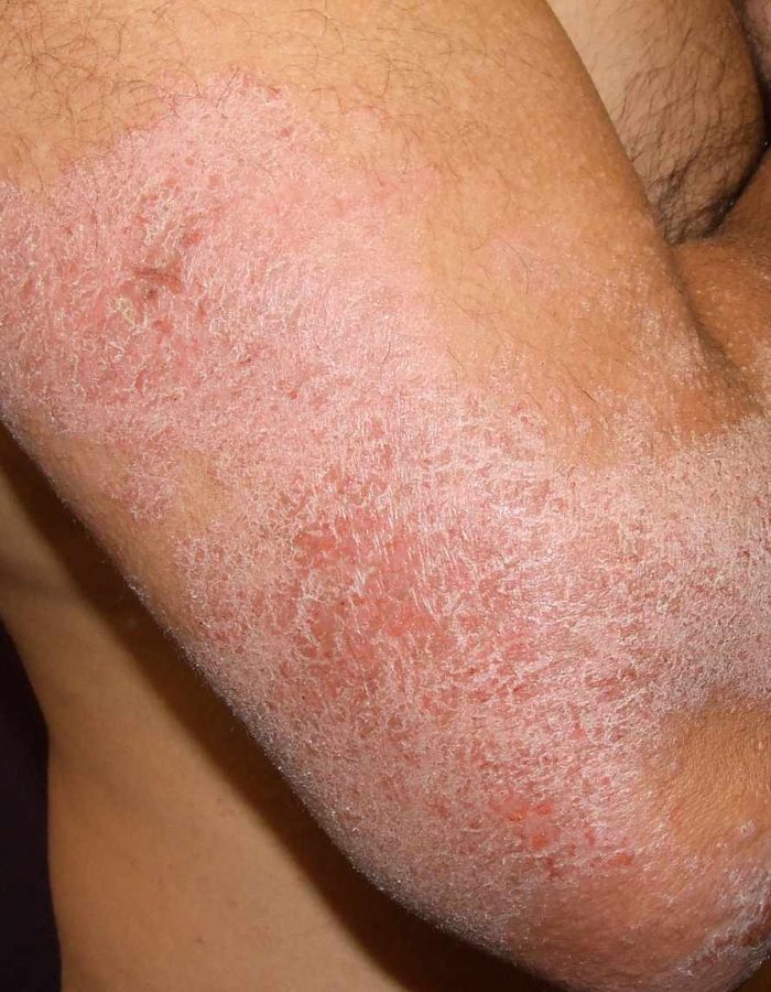 Atopic Dermatitis