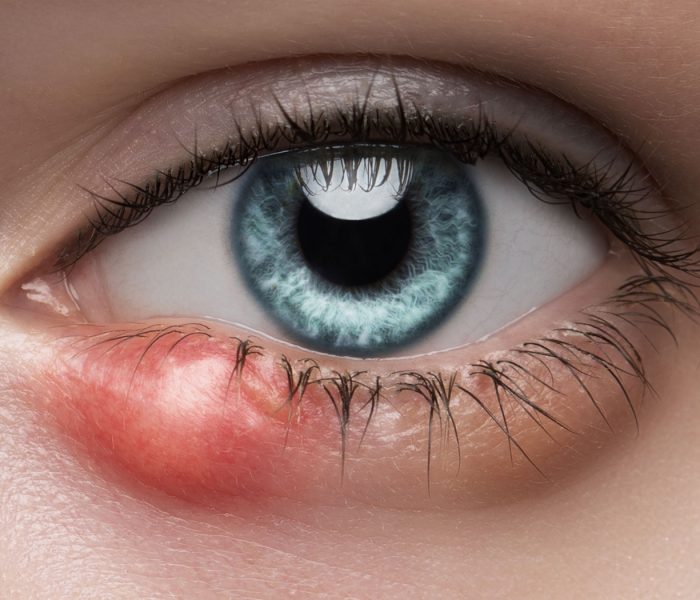 Chalazion