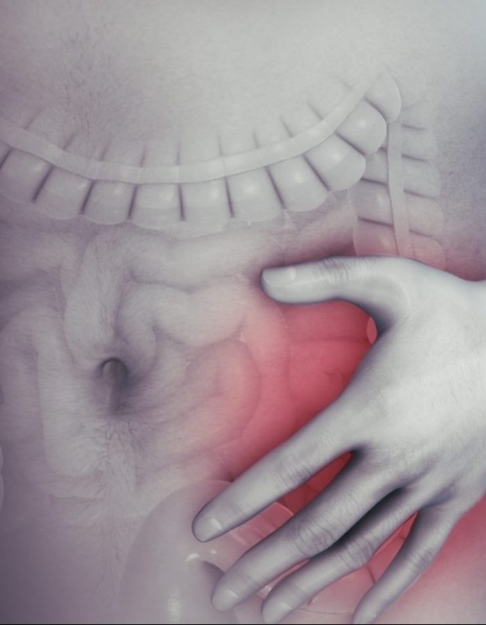 Irritable_bowel_syndrome