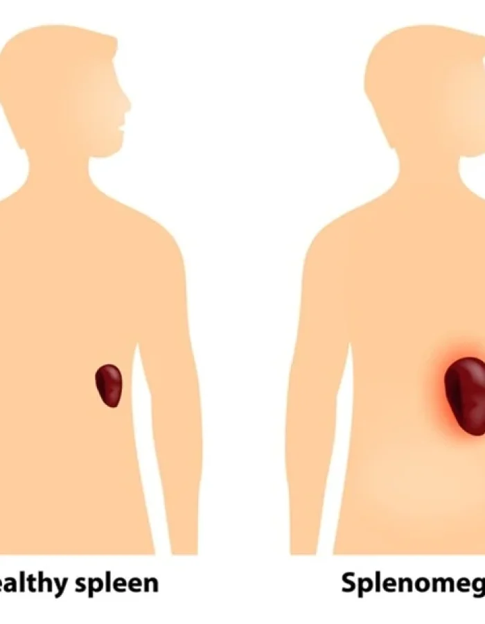 SPLENOMEGALY