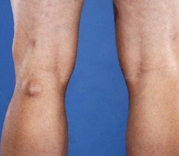 Homeopathic Treatment for Baker’s Cyst